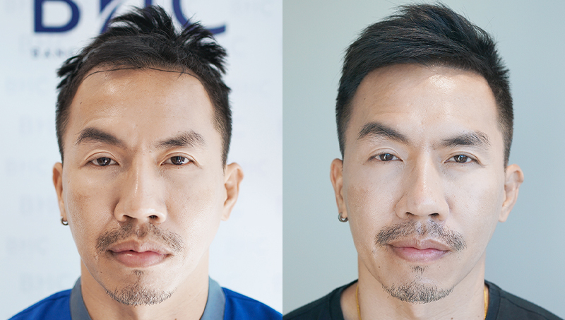 FUE DHI Hair Transplant - Bangkok Hair Clinic Health Care Booking Service | Thailand FUE DHI Hair Transplant - Bangkok Hair Clinic Health Care Booking Service | Thailand