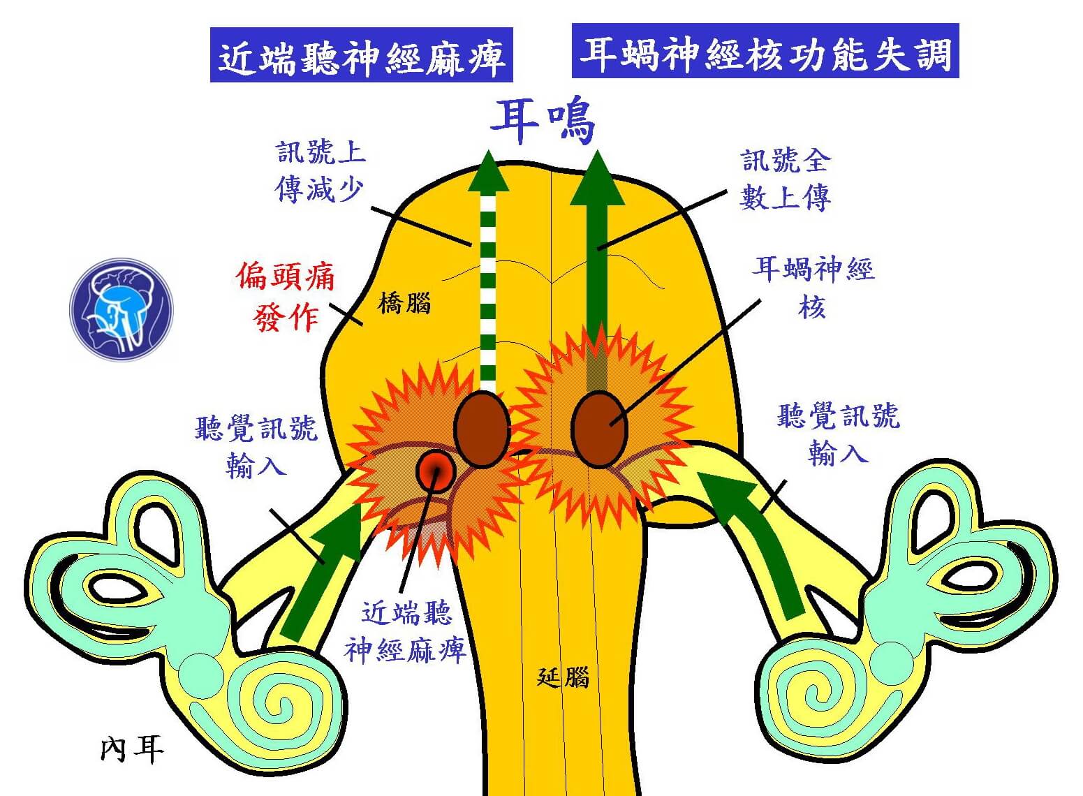 ▼偏頭痛性近端聽神經麻痺（左圖）與耳蝸神經核功能失調（右圖）引起耳鳴的機轉。（圖／今健康）