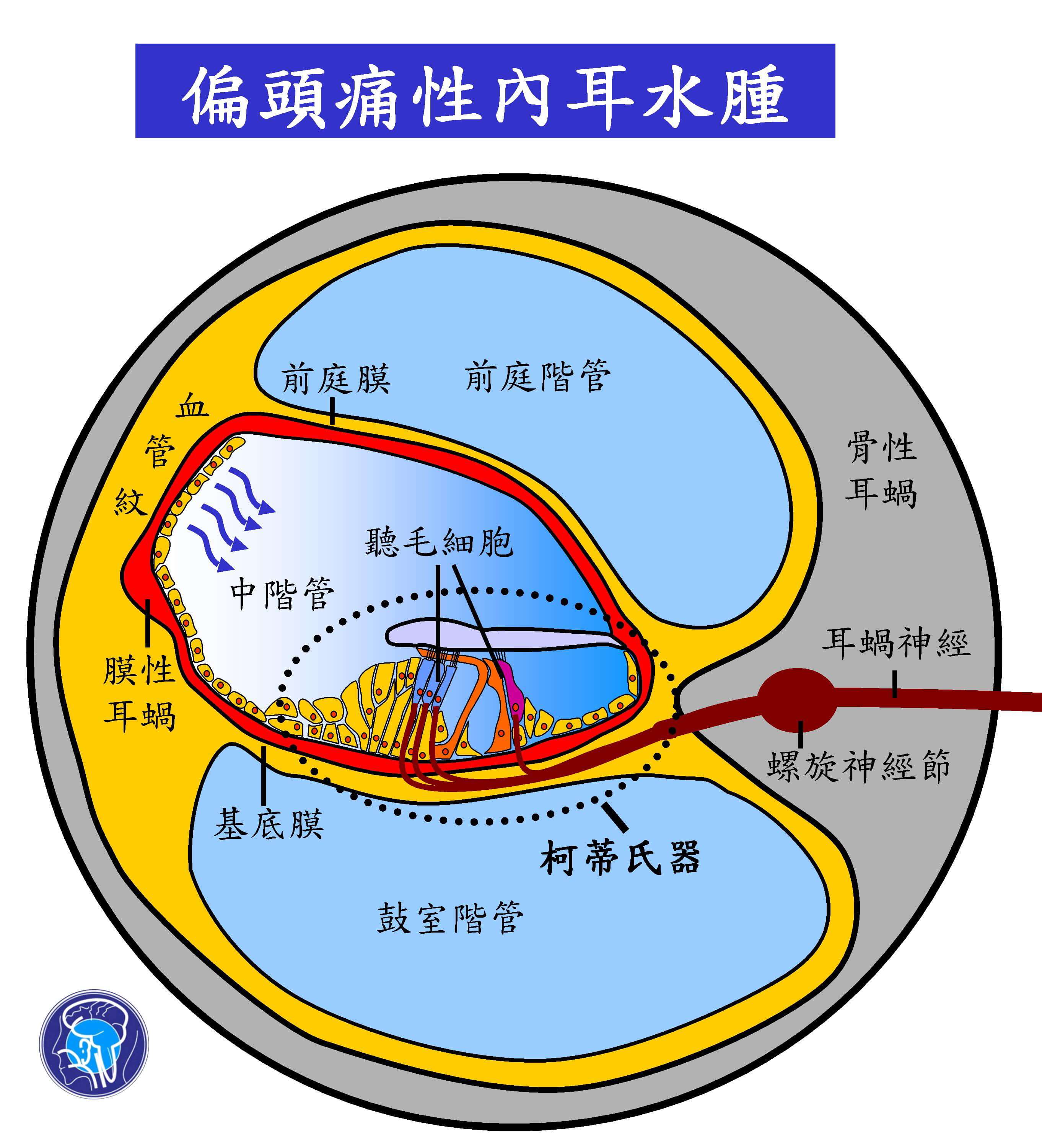 ▼偏頭痛性內耳水腫引起耳鳴的機轉。（圖／今健康）