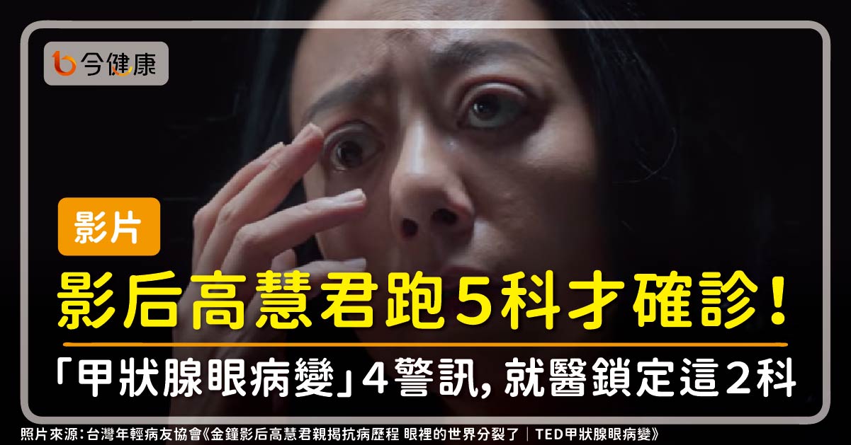 【影片】影后高慧君跑５科才確診！眼凸、模糊「甲狀腺眼病變」４警訊，就醫鎖定這２科