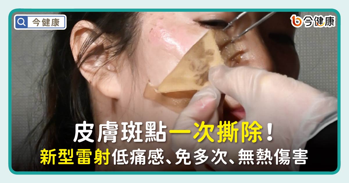 皮膚斑點一次撕除！新型雷射低痛感、免多次、無熱傷害成趨勢