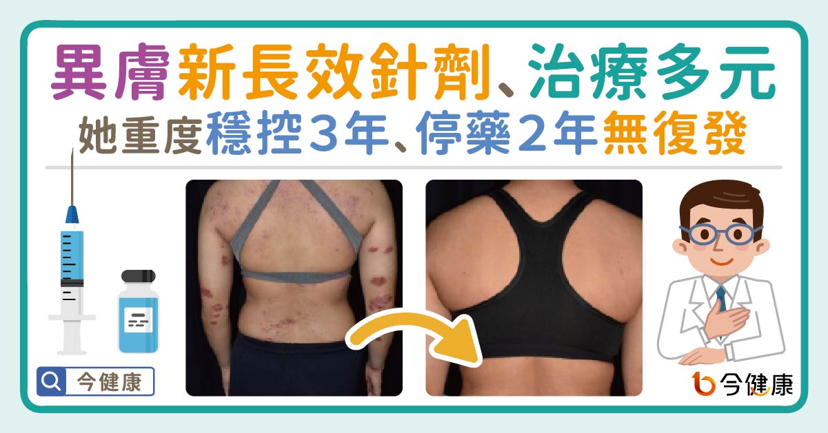 異膚新長效針劑與多元治療！她重度穩控３年、停藥２年無復發