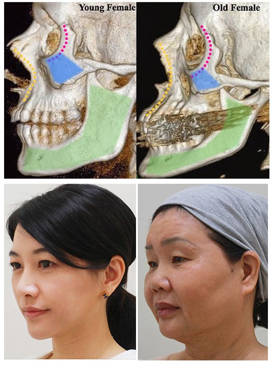 ▲比較圖可看出下顎線緊緻程度決定臉型精緻度、大小、立體度的重要關鍵部位。