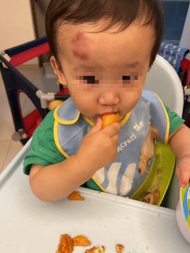一名1歲多男童疑走路跌倒，額頭腫起瘀青一整片， 家長抱怨園方沒通知也沒就醫。(圖/採訪中心)