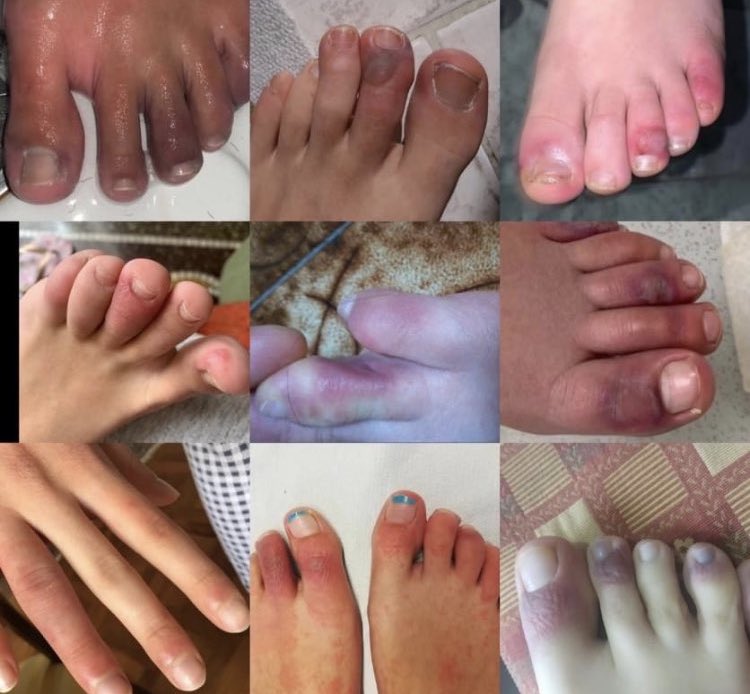 13歲少女感染「新冠腳趾」,雙腳腫脹泛紫、長滿水泡,痛得無法穿鞋,至今9個月連走路都有困難。(圖/擷取自《Dawn Wahezi》Twitter)