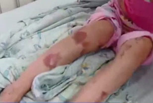 大陸有名女童因大量接觸殺蟲藥劑,進而導致皮膚嚴重潰爛。(圖/翻攝自微博)