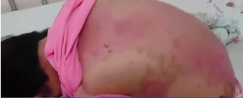 大陸有名女童因大量接觸殺蟲藥劑,進而導致皮膚嚴重潰爛。(圖/翻攝自微博)