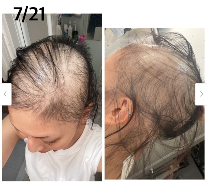 女子在就診並進行檢查後也無法確認任何可能導致脫髮的原因。（圖／翻攝自Ameblo）