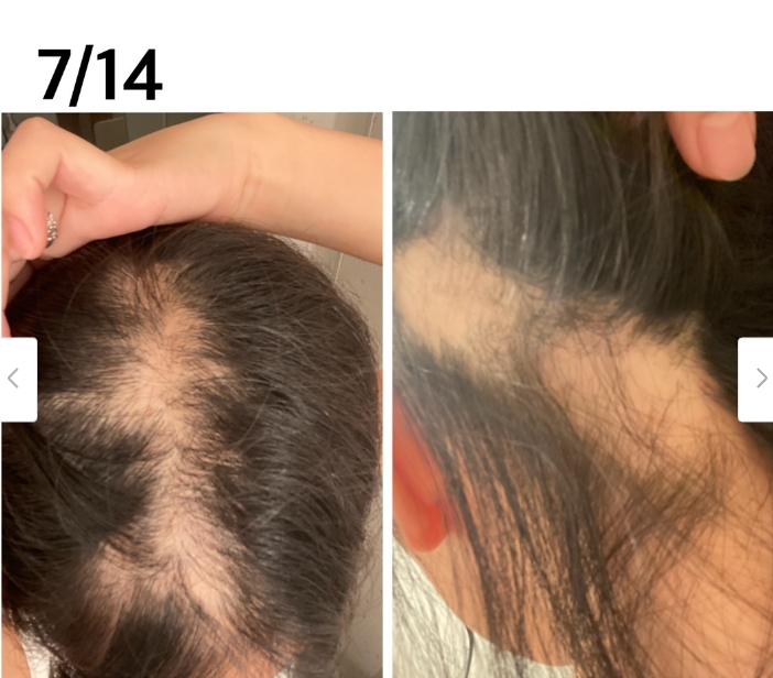 女子在接種莫德納疫苗的後2週，頭皮已可以明顯被看見。（圖／翻攝自Ameblo）
