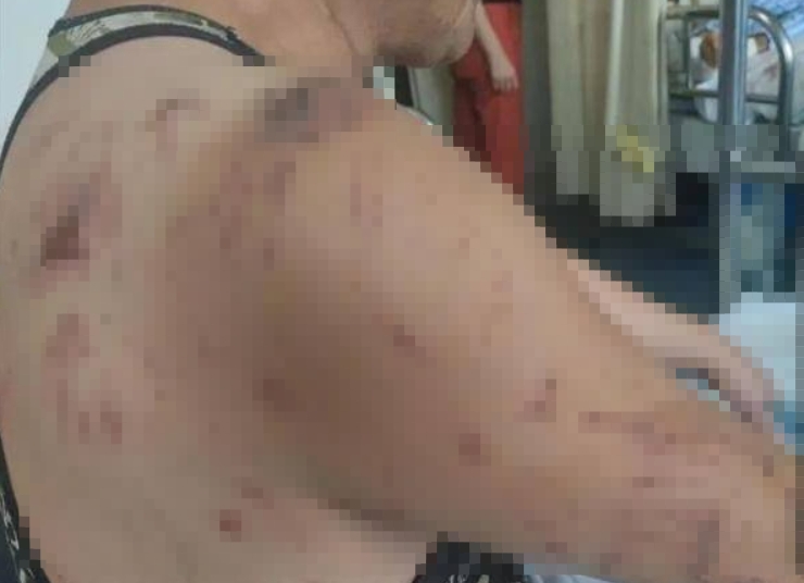 女傷者爸爸為在爆炸中救女傷者一命而推他下樓。(圖/翻攝自「極目新聞」微博)