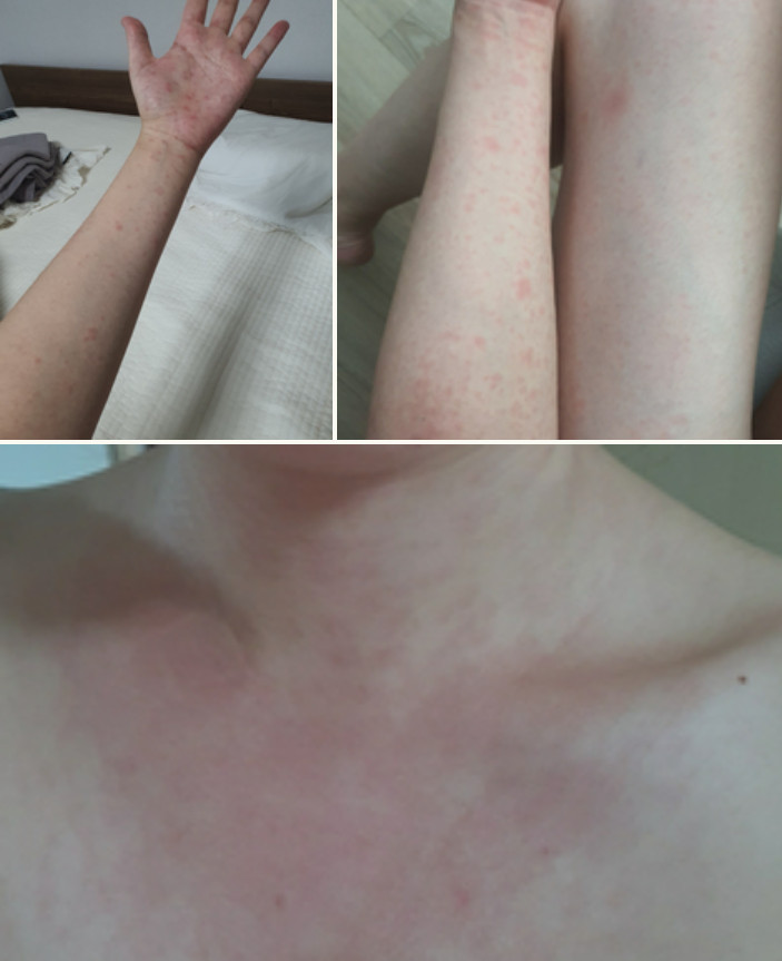 女網友分享自己全身長紅斑的照片。（圖／Naver Blog）