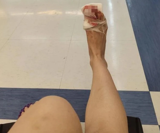 女大生意外發現腳指甲被撞到噴飛。（圖／翻攝Dcard）