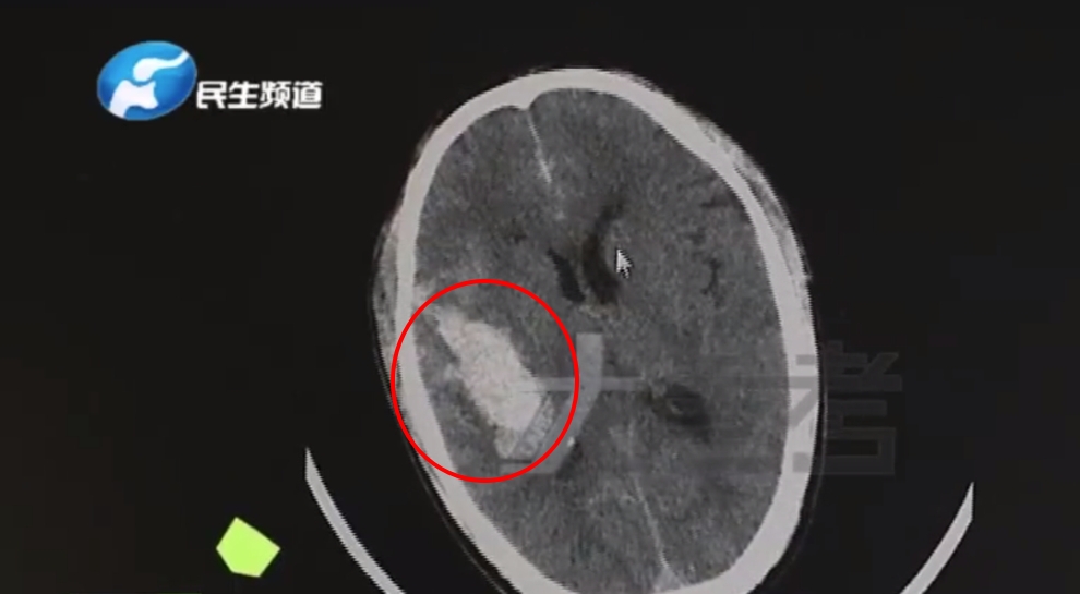 醫生發現這名男子左側大腦處，有個血管瘤破裂出血跡象。（圖／翻攝自「大參考」微博）