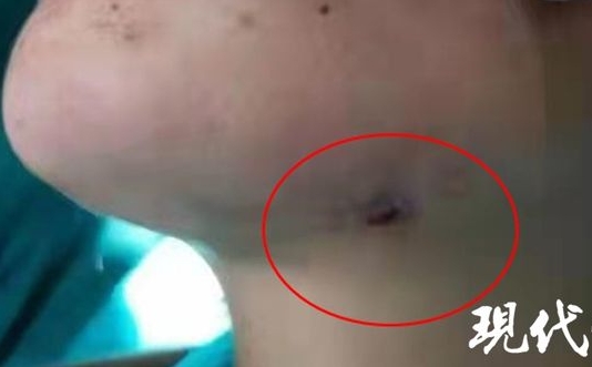 大陸一名女子智齒反覆發炎,但他不去看醫生,反而狂吃消炎藥硬扛。(圖/翻攝自「現代快報」微博)