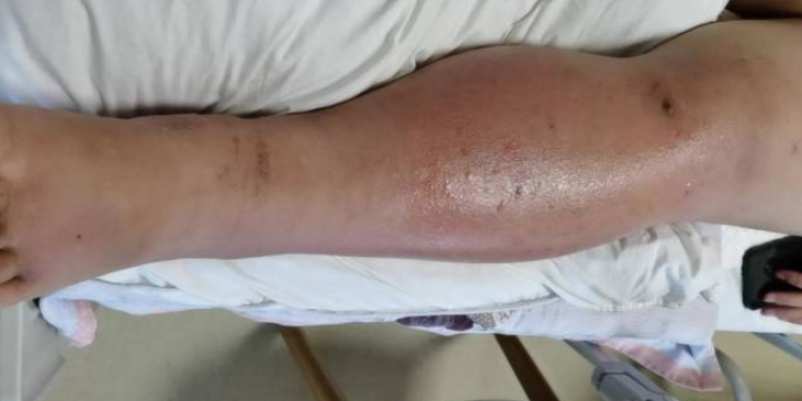 孕婦被蚊子叮咬後，竟意外導致左腿腫脹，差點危及寶寶生命。（圖／翻攝自「中原網」微博）