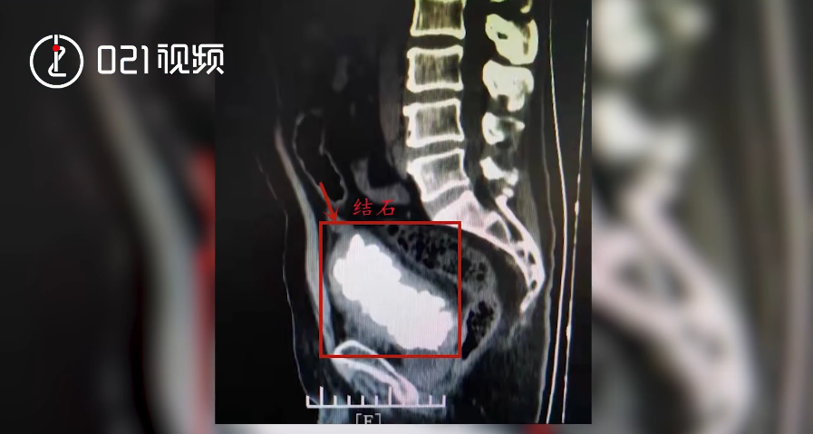 大陸上海市金山區一名張姓男子，近日因血尿問題送醫急救，結果醫生開刀後竟從他的膀胱內取出多達200顆結石。（圖／擷取自《021視頻》微博）
