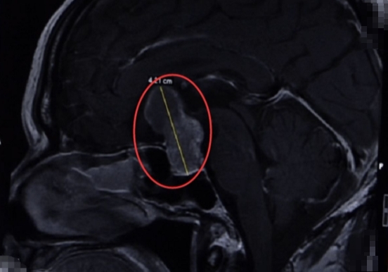 58歲男子腦部腫瘤影響視力。（圖／翻攝自「廣州日報」微博）