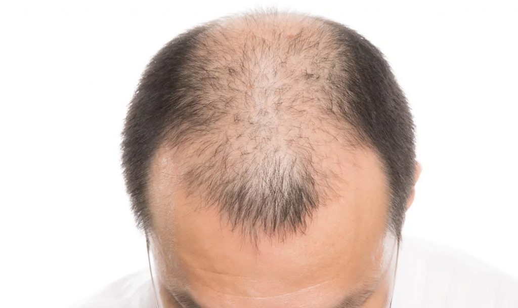美國FDA批准了首支針對圓禿的口服藥物，有望讓禿頭患者重拾茂盛髮量。（示意圖／翻攝自pexels）