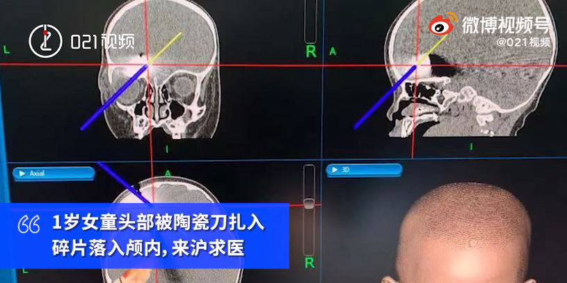 上海女童拿刀玩耍,不小心將刀插入頭內。(圖/翻攝自微博)