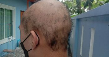 泰國一名19歲少年，在接種完2劑大陸國產科興疫苗（Sinovac）3天後，突然大量掉髮成光頭。（圖／翻攝自推特）