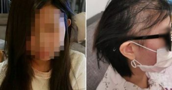 馬來西亞女子打完2劑AZ過後掉了近7成髮量。（圖／翻攝自「@ytc1926」Twitter）