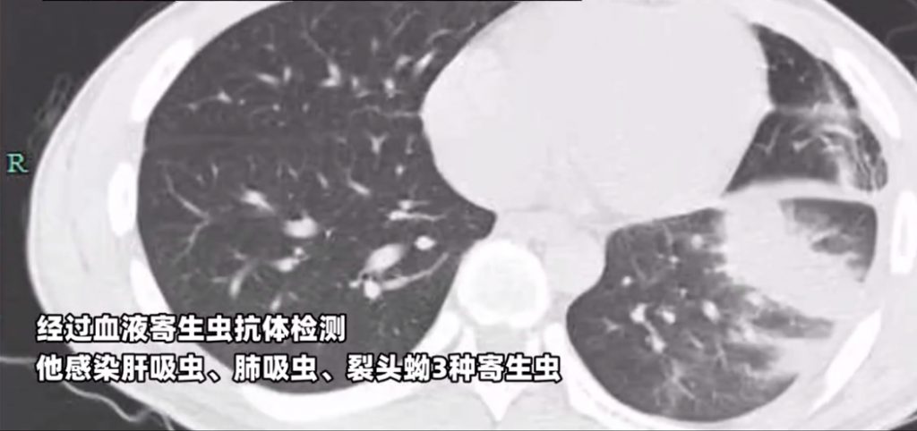 男子因小時候常喝生水，竟遭寄生蟲入侵。（圖／翻攝自「錢江晚報」微博）