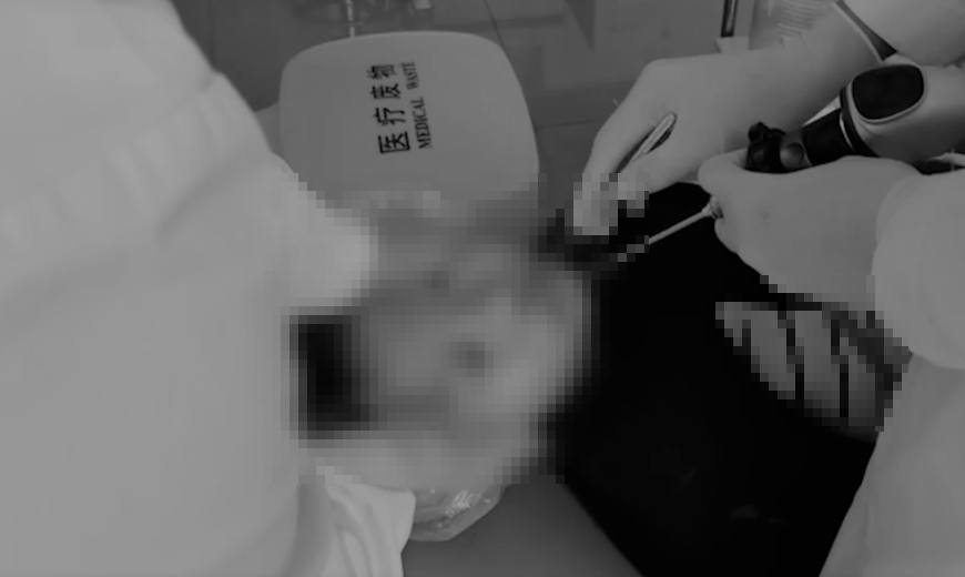 一名男孩鼻塞半個月,竟是因為鼻子內有一隻「水蛭」。(圖/翻攝自「沸點視頻」微博)