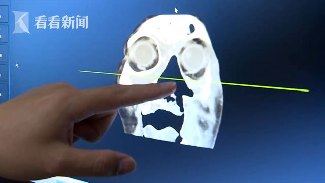 ▲醫師表示，老翁的鼻腔是空的，這些活蛆是在「狹縫中求生存」。（圖／翻攝自看看新聞）