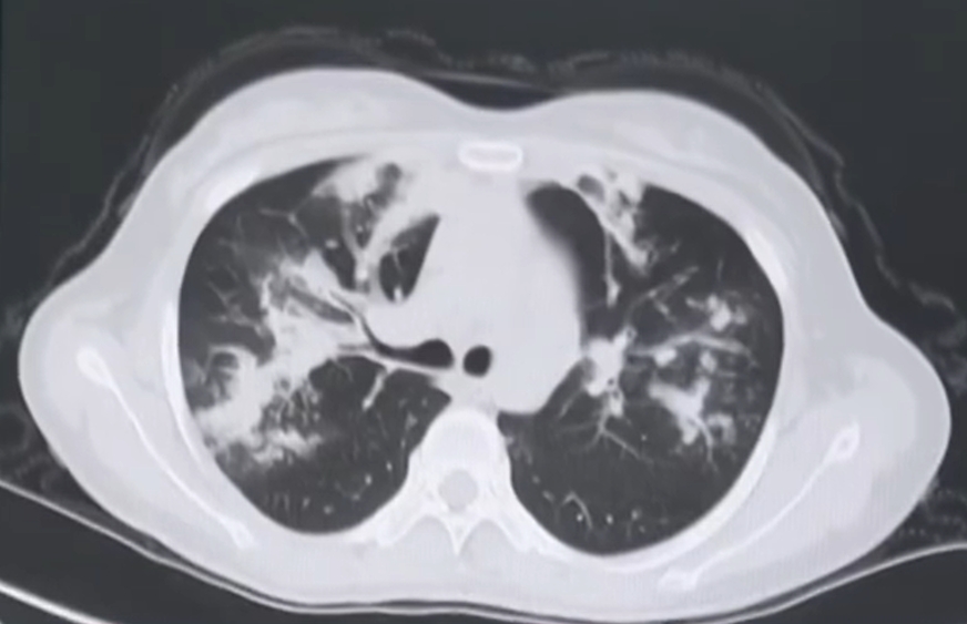 醫生指出，女子肺部病變範圍較廣也較大。（圖／翻攝自「經視直播」微博）
