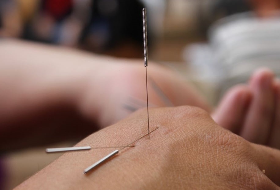 新竹婦人針灸過程中被刺破肺部、隨後更因延誤就醫而身亡。(示意圖/翻攝自Pixabay)