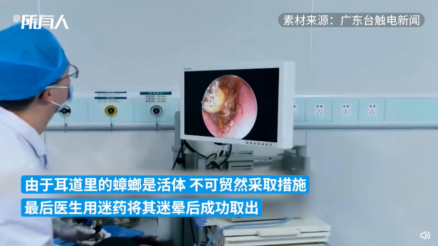 活體蟑螂卡耳裡。(圖/微博 澎湃新闻)