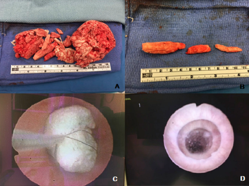 留在男子體內最大的泡棉腫塊，長達11公分。（圖／擷取自《Urology Case Reports》官網）