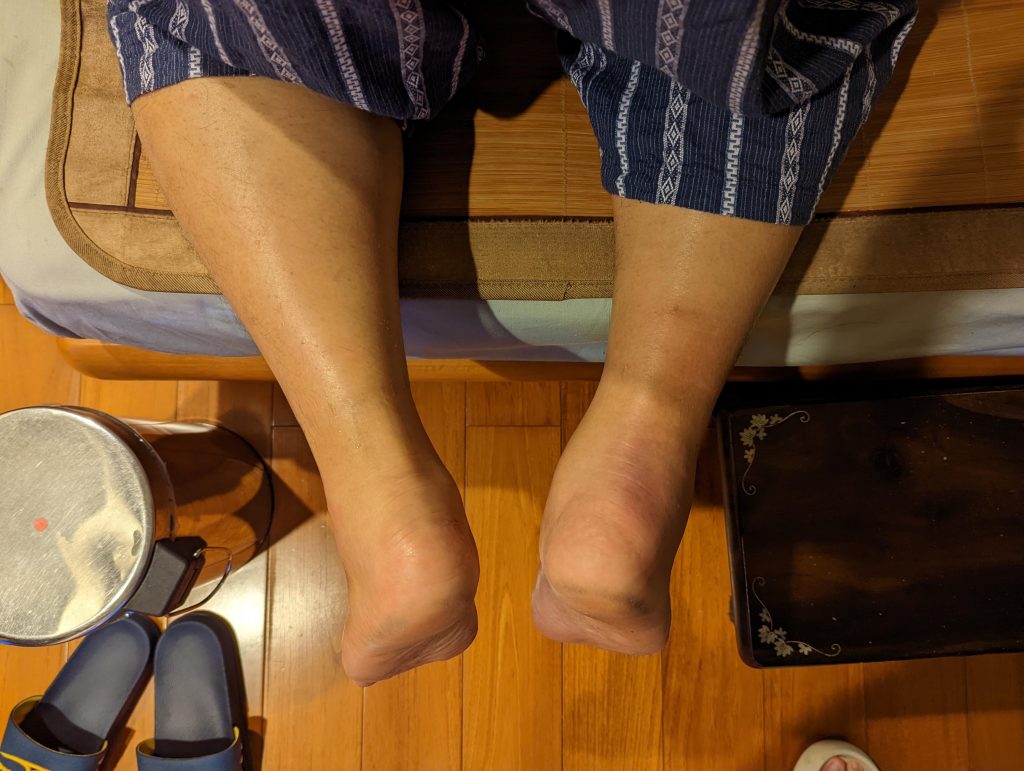 高尿酸大多無症狀,但日久未改善恐形成結晶卡在關節,最終導致所謂的「痛風」,接著關節處將出現「紅腫熱痛」情況,尤其是手腳末梢小關節。(圖/由記者拍攝)