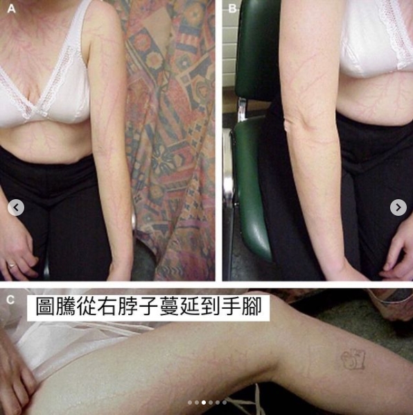 利希滕貝格圖騰通常24小時內會消失。（圖／翻攝自IG）
