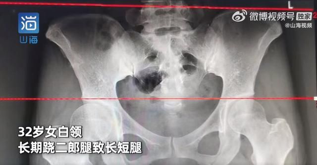 大陸一名女白領因長期翹腳導致骨盆上提。(圖/翻攝自微博/山海視頻)