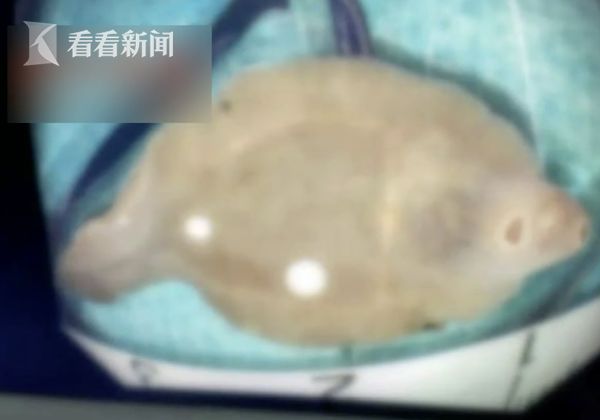 女子就醫竟發現體內有超大寄身蟲。(圖/翻攝自微博)