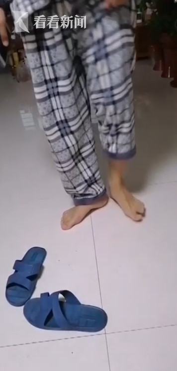 男大生因長期翹腳導致小腿的腓總神經損傷。影響走路。(圖/翻攝自微博/看看新聞)