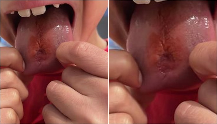 酸甜糖造成幼童舌頭表層受損。（圖／翻攝自Facebook／CPR Kids）