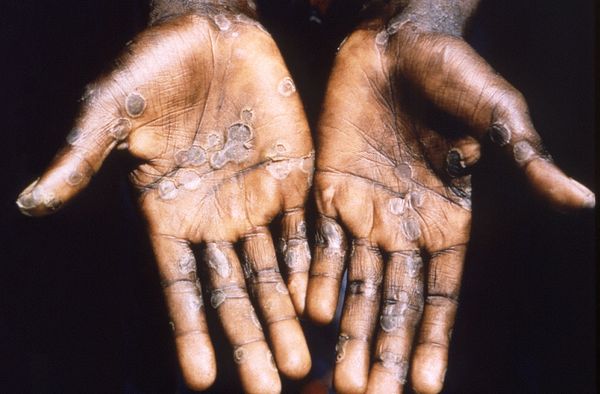 非洲流行病猴痘（Monkeypox）近期已逐漸擴大至歐洲及北美國家。（圖／路透社）