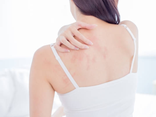 蕁麻疹是臨床上常見的皮膚疾病，夏天天氣炎熱，皮膚受到的刺激增加，導致蕁麻疹更易發生。（示意圖／取自Pexels）
