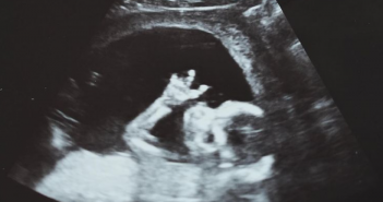 瘦子今（29）日在IG上發文，貼出寶寶比著「YA手勢」的逗趣超音波照，暗示著夫妻倆好「孕」降臨！（圖／翻攝自IG／@mjfceo）