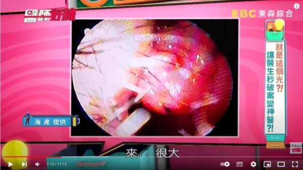 海產過了半年才去檢查，發現鼻子內竟長血管瘤。（圖／翻攝自YouTube／醫師好辣）