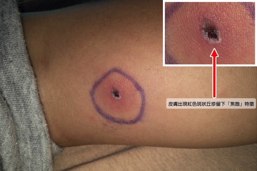 男童皮膚出現紅色斑狀丘疹留下「焦痂」特徵。(圖/台中慈濟醫院提供)