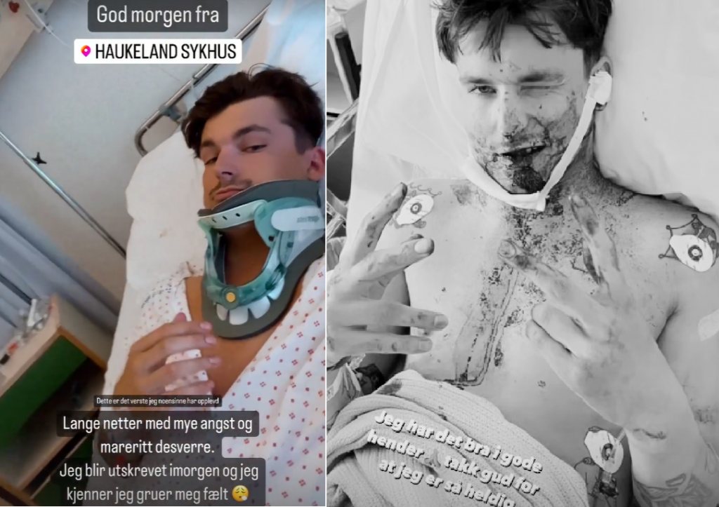 挪威真人秀男星塞爾沃爾（Adrian Sellevoll）跳海失敗，造成頸部、下巴3處嚴重骨折。（圖／翻攝自Instagram）