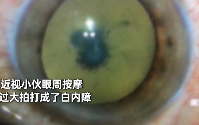 一名28歲男子竟按摩眼部「按出白內障」!(圖/翻攝自微博)
