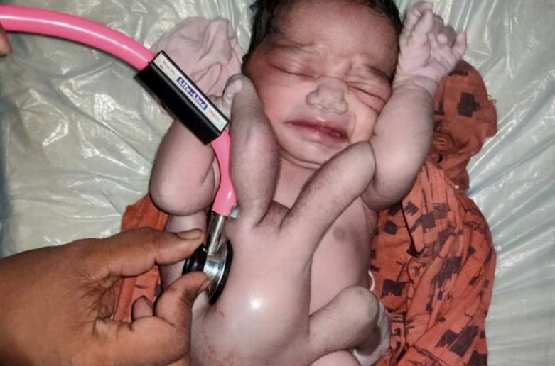 印度一名婦人生下有四手四腳的嬰兒。（圖／翻攝自推特）