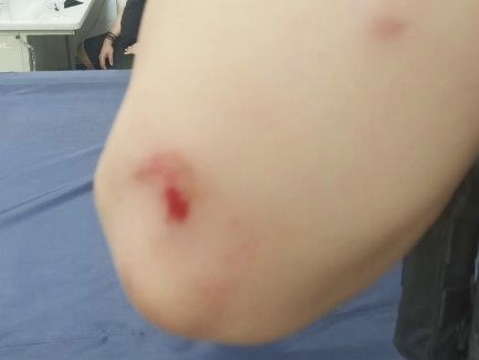 嫌犯拒捕造成警員手肘擦傷。(圖/警方提供)