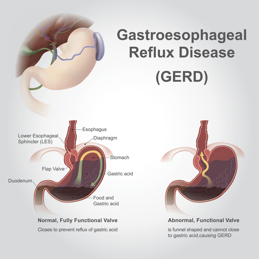 gastric reflux disease