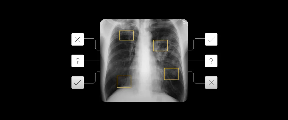 AI detects tuberculosis on chest x-rays. Image used with permission from National Library of Medicine, PubMed ID 25525580.