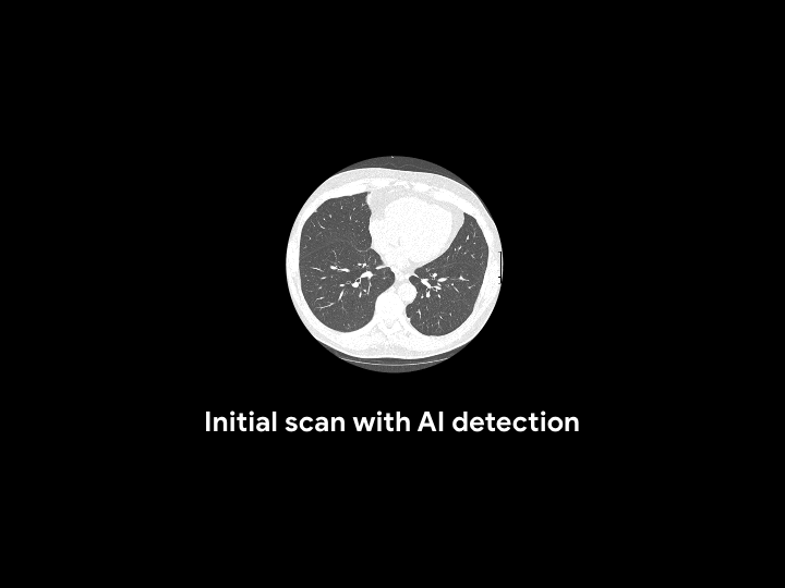 A.I. Took a Test to Detect Lung Cancer. It Got an A. - The New York Times